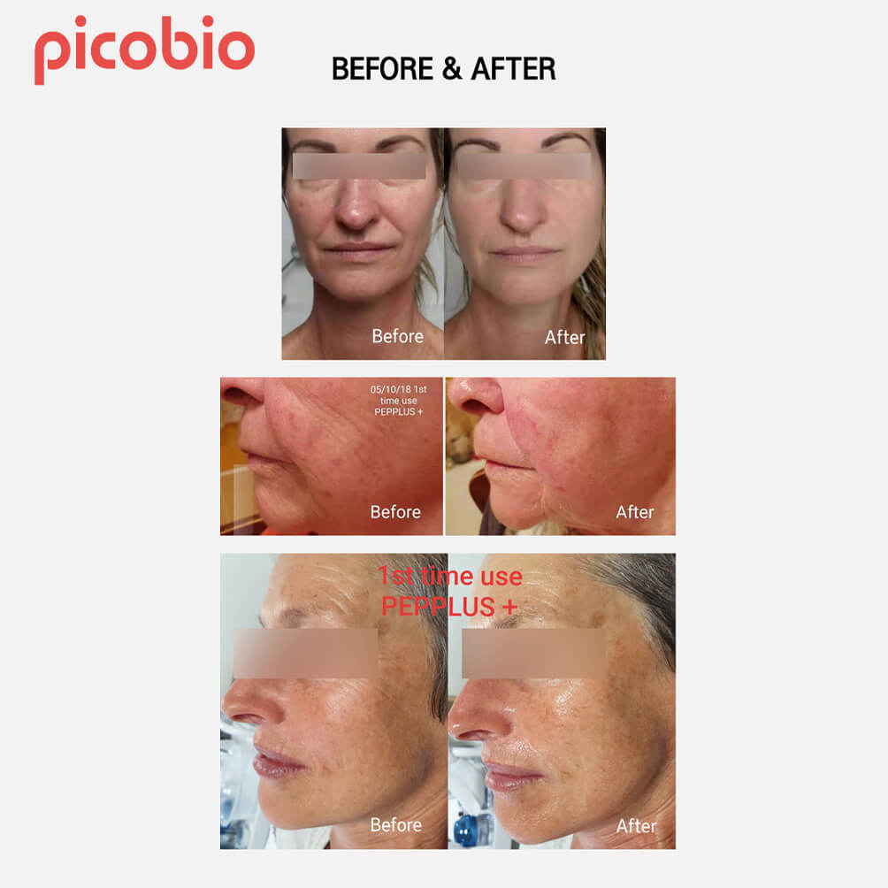 Picobio_Pepplus_Special-Skin-Care-Lifting-Program_12