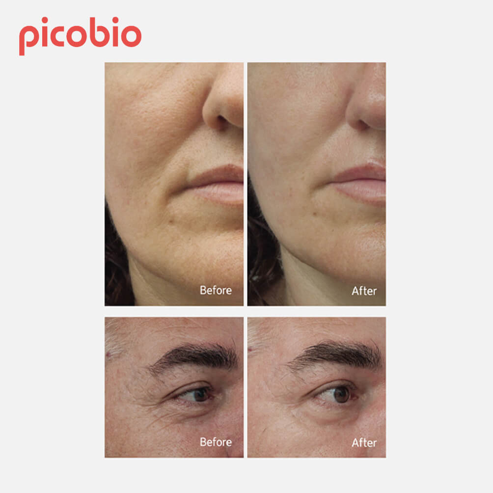 Picobio_Pepplus_Special-Skin-Care-Lifting-Program_14